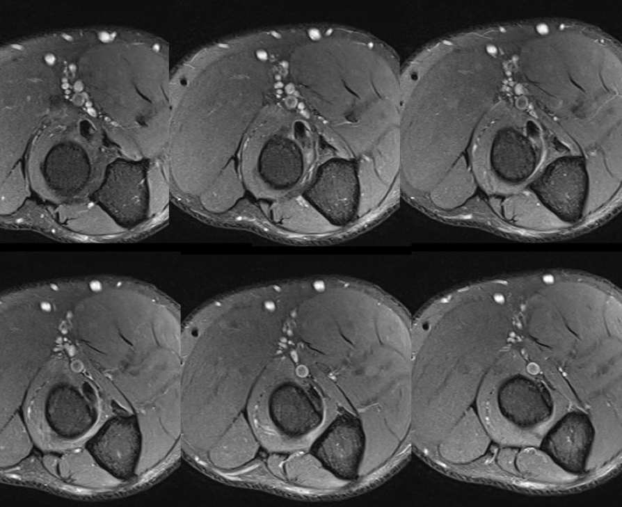 Figure 2 for case biceps tendinopathy and partial tear